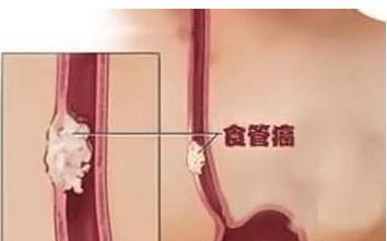 食道癌患者要如何进行饮食调理？看完你就知道了
